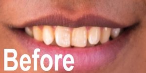 crooked, crowded, malocclusion before treated image by one touch smile ahmedabad, gujarat, india